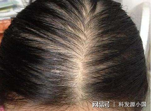 植发一根头发大概多少钱_植发一根头发值多少钱-第3张图片-游点攻略